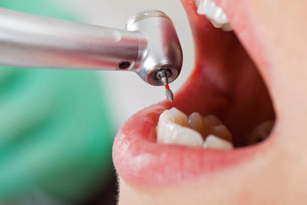 Best Emergency Wisdom Tooth Extraction in Harbour Heights, FL